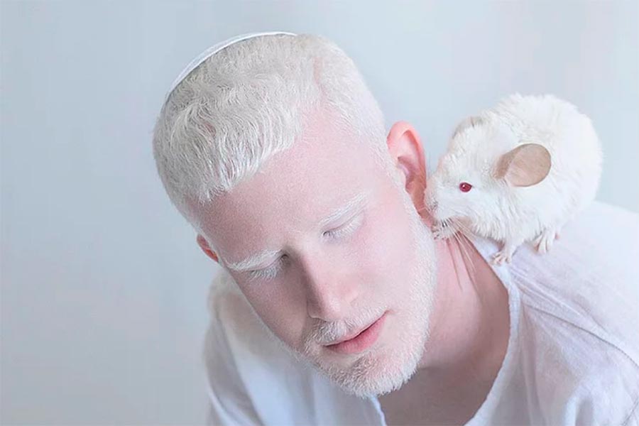 Люди-альбиносы people with albinism