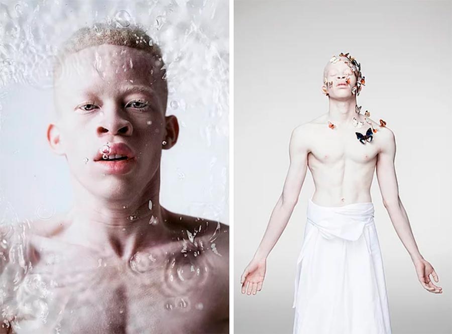 Люди-альбиносы people with albinism