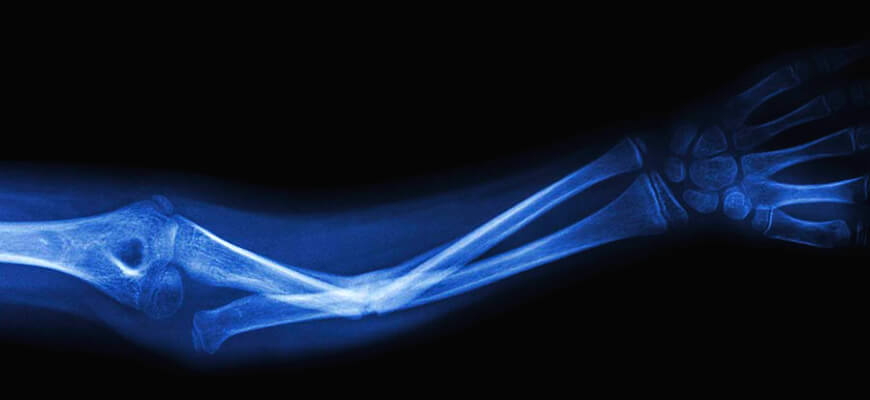 В Сиднее разработали срастающиеся с костями керамические импланты