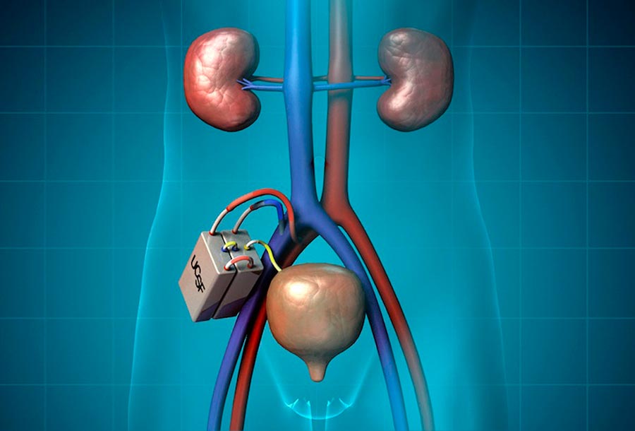 technologies технологии 2018 Имплантируемая искусственная почка implantable artificial kidney