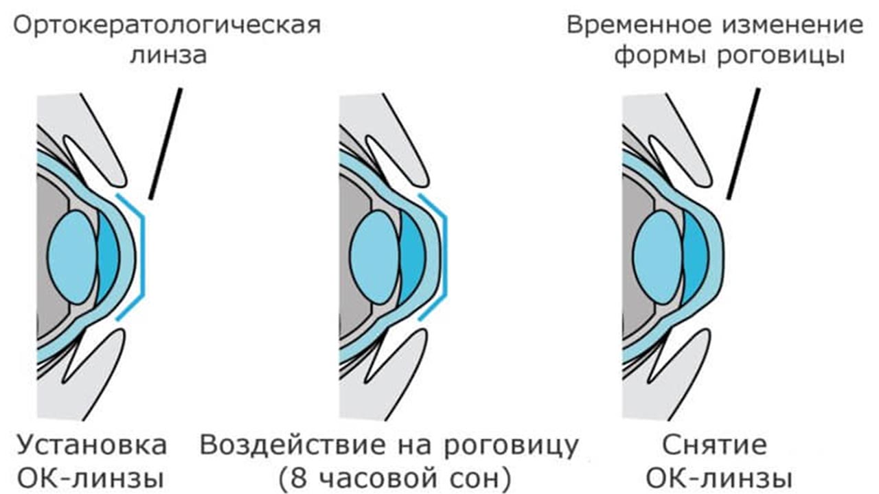 ночные линзы для лечения глаз